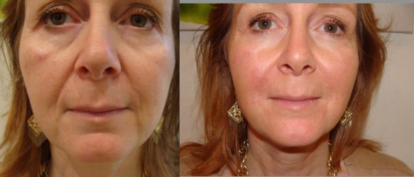 Derma Fillers before and after